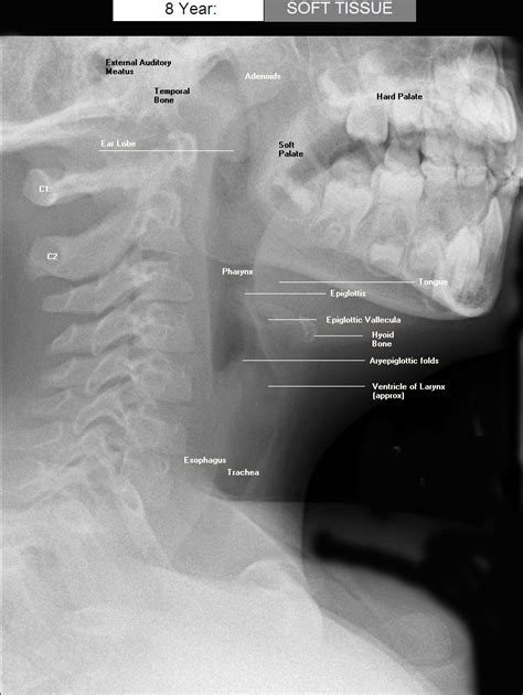 Soft Tissue Neck LAT labelled - pedXray.com