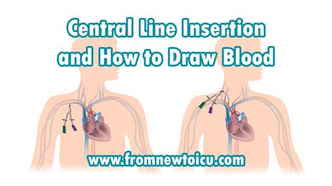 Central Line Insertion and How to Draw Blood — From New to ICU - South Wales Intravenous Access ...