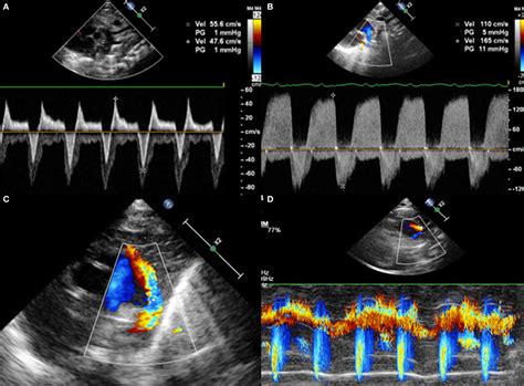 Patent Ductus Arteriosus Echo