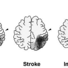 Overlapped lesions in the parietal lobe in patients with abnormal ...