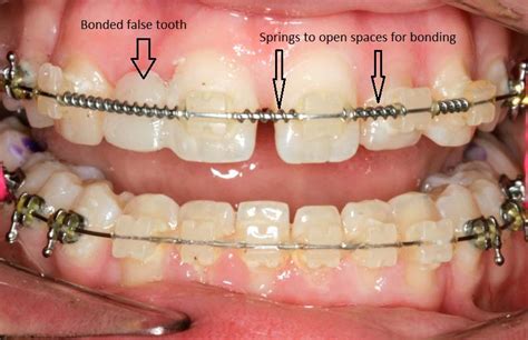 Missing Lateral Incisor - Holistic Dentistry Sarkissian DDS