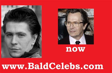 BaldCelebs.com: Gary Oldman (Actor) Balding/ Hair Transplant : The Dark ...