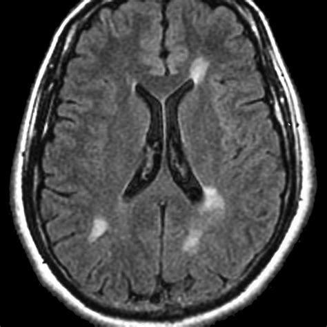 Neurology Shelf Review Part 2