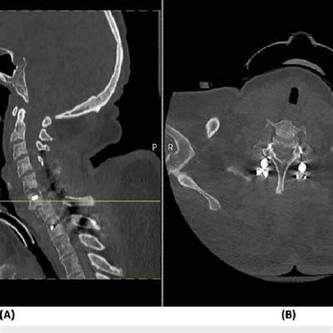 CT scan of the final C6-7 fracture reduction (A) Sagittal spine CT... | Download Scientific Diagram