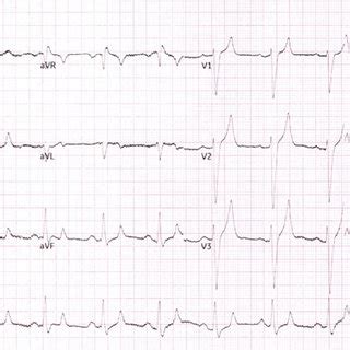 ECG showing tall and tented T waves. | Download Scientific Diagram