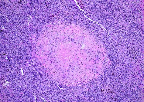 Lymphogranuloma Venereum Histology