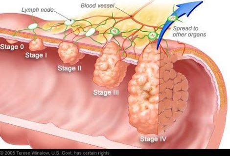 Stage 4 Colon Cancer | Spooky2 Reviews