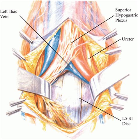 Superior Hypogastric Sympathetic Plexus | Neupsy Key