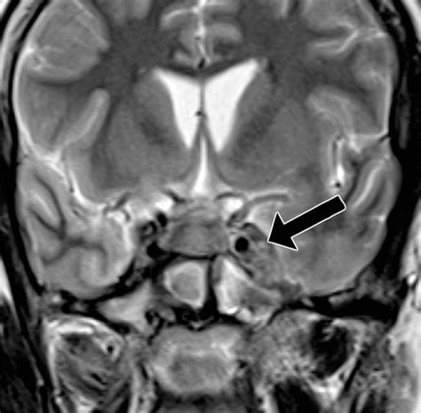 Imaging Spectrum of Cavernous Sinus Lesions with Histopathologic ...