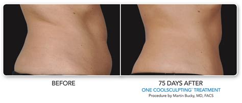 CoolSculpting Before & After Photos | Dermatology Consultants