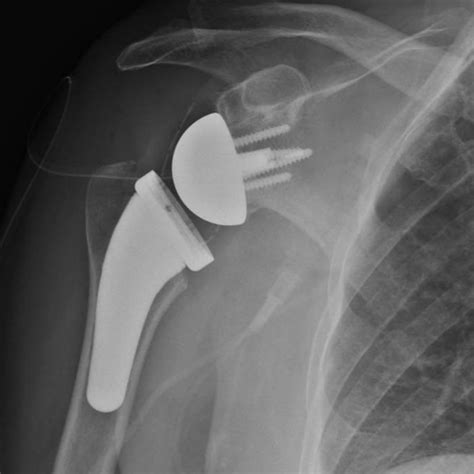 My Reverse Shoulder Replacement - Patient Story - Orthopedic AssociatesBlog | Denver Top ...