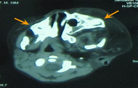 Isolated Hemifacial Hyperplasia : Journal of Craniofacial Surgery