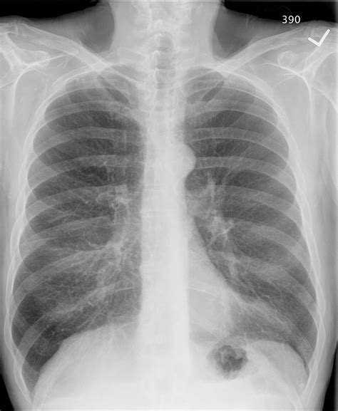 Pulmonary Roundtable: Abnormal CT scan