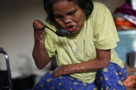 Sad Story Of A Teenager Living With Leprosy │Stigma Associated With The ...