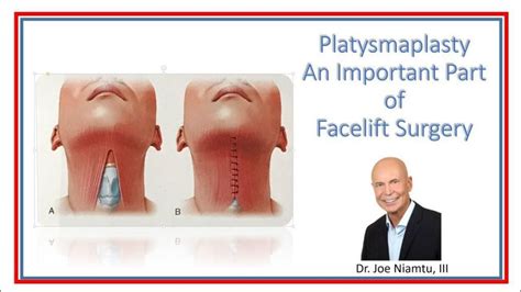 Platysmaplasty: an important part of face and neck lift surgery