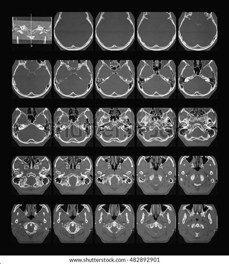 Temporal Bone Ct Anatomy - Anatomical Charts & Posters