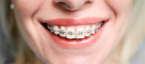 Brackets para mejorar tu sonrisa - Dental Roca