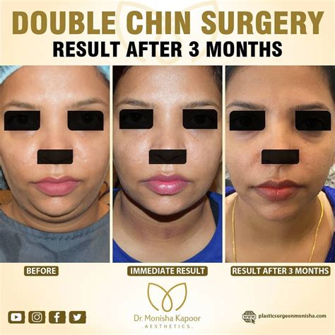 Remove double chin in facetune - lanawing