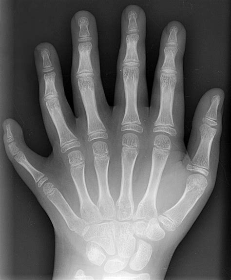 Surgery for polydactyly | General center | SteadyHealth.com