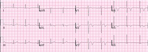 Wellen’s waves are biphasic with a tight positive, ... | GrepMed