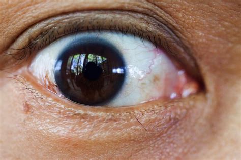 10 Signs of Cataracts - Facty Health