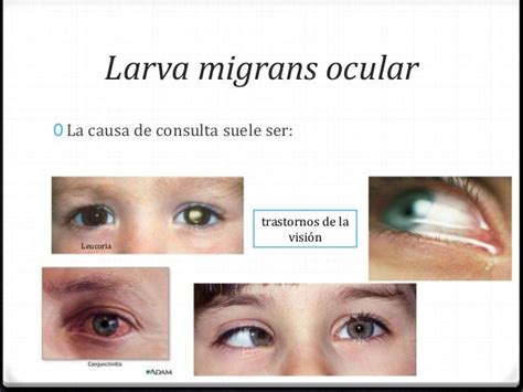 Ocular Larva Migrans.