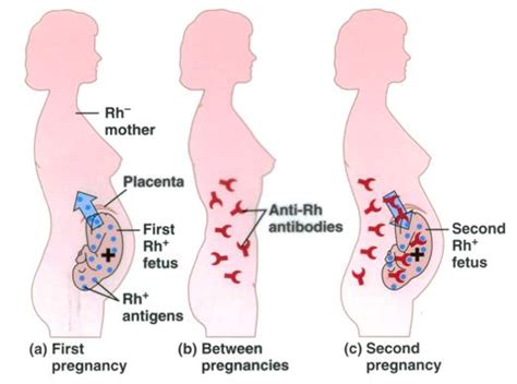 Utility of Anti-D Immunoglobulin(Rho Gam) During First Trimester Pregnancy – Core EM