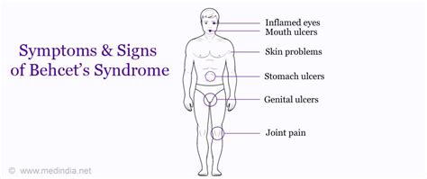 Behcet’s Disease - Its Symptoms, Causes And Types