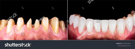 8 Single Tooth Implant Before After Images, Stock Photos & Vectors ...