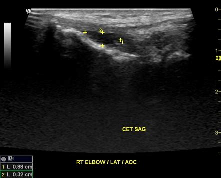 Common extensor tendon tear - elbow | Radiology Case | Radiopaedia.org