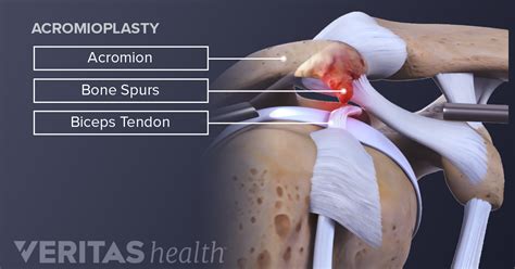 Shoulder Bursitis Surgery