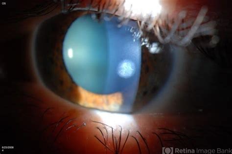 Corneal Scar - Retina Image Bank