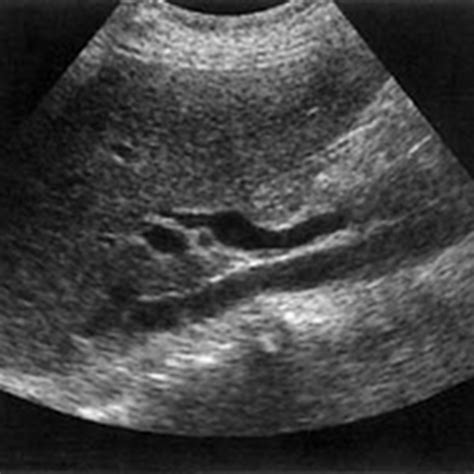 Bile duct measurements use ultrasound - Radiology Imaging