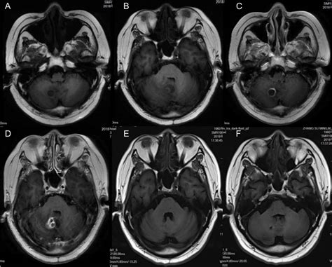 | Magnetic resonance imaging (MRI) of the patient shows cerebellar... | Download Scientific Diagram