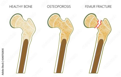 Vector illustration of a healthy human thigh bone, osteoporosis of femur and femoral neck ...