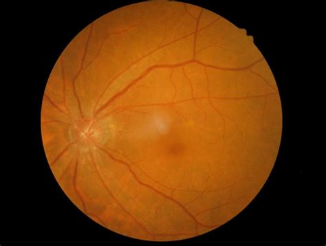 Early Symptoms of Macular Dystrophy