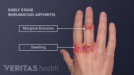 Proximal Interphalangeal (PIP) Joints | Arthritis-health