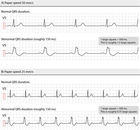 The Qrs Complex Ecg Features Of The Q Wave R Wave S Wave And Duration | Free Download Nude Photo ...