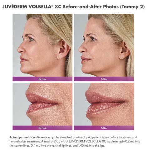 How Juvederm Vollure & Volbella Fill Medium & Deep Lines