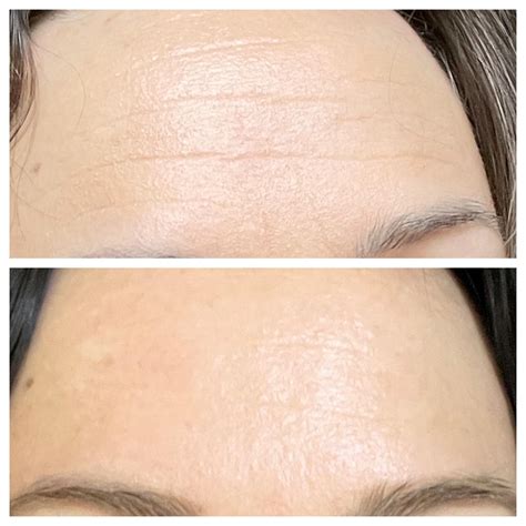 Wrinkle Removal Cream Reddit Retinol Clearance | centralcountiesservices.org