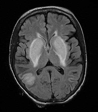 Uremic encephalopathy | Radiology Reference Article | Radiopaedia.org