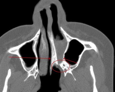 File:Choanal atresia computed tomography 01.jpg - Embryology