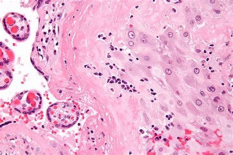 Chronic deciduitis - Libre Pathology