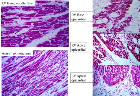 Trabeculae Carneae Histology