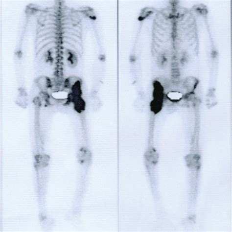 Triple-phase bone scan of the posterior (left) and anterior (right ...