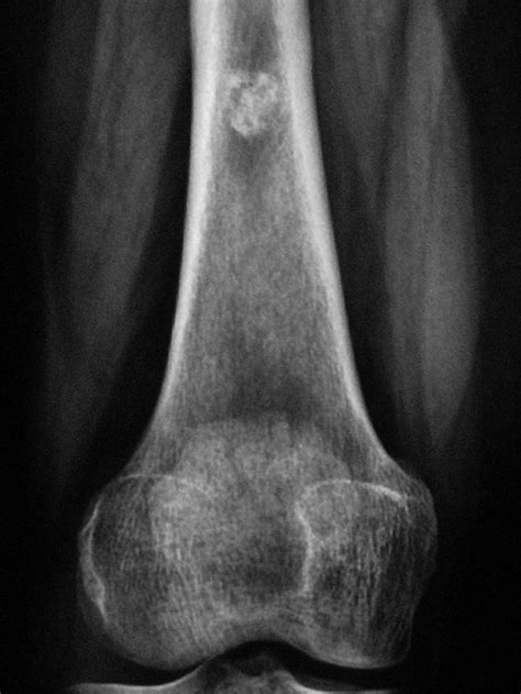 Presence of an Enchondroma in the Metaphysis of Femur of a 36-Year-Old... | Download Scientific ...