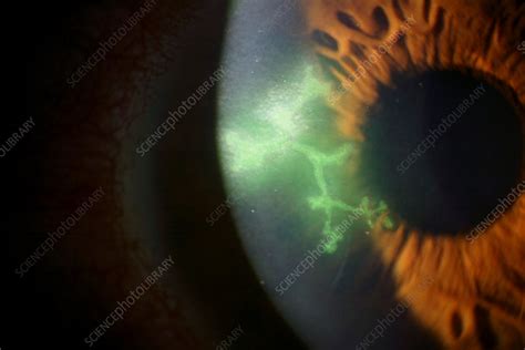 Herpes simplex keratitis, slit-lamp examination - Stock Image - C034/6878 - Science Photo Library