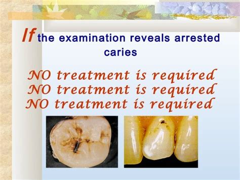 Caries Treatment