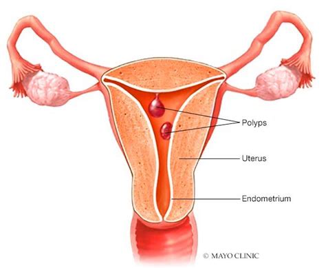 Pólipos uterinos - Síntomas y causas - Mayo Clinic