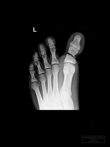 LEFT FOOT BROKEN BIG TOE X-Ray | Sinister Signs